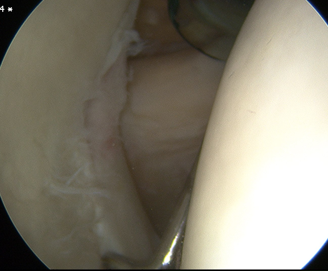 Shoulder Scope Low Anterior Portal